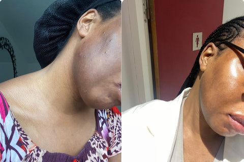 Anti-hyperpigmentation face kit